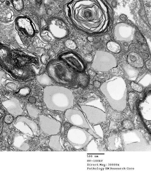 3A2 Axonal Degeneration (Case 7) EM 025 - Copy