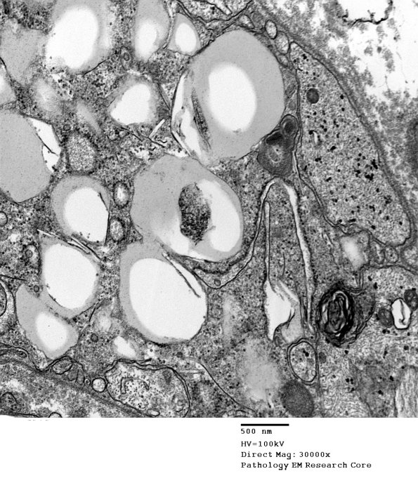 3A3 Axonal Degeneration (Case 7) EM 026 - Copy