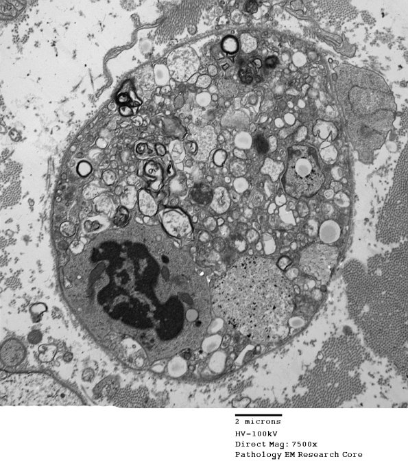 3B1 Axonal Degeneration (Case 4) EM 084 - Copy
