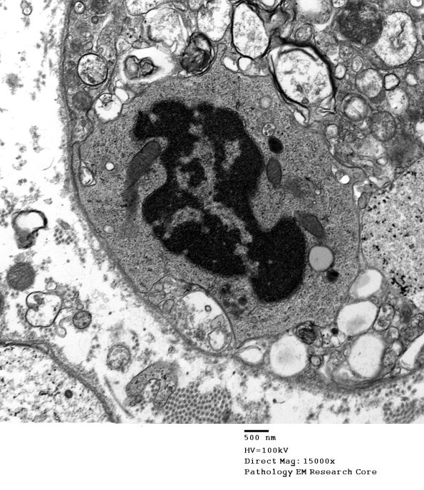 3B2 Axonal Degeneration (Case 4) EM 085 - Copy