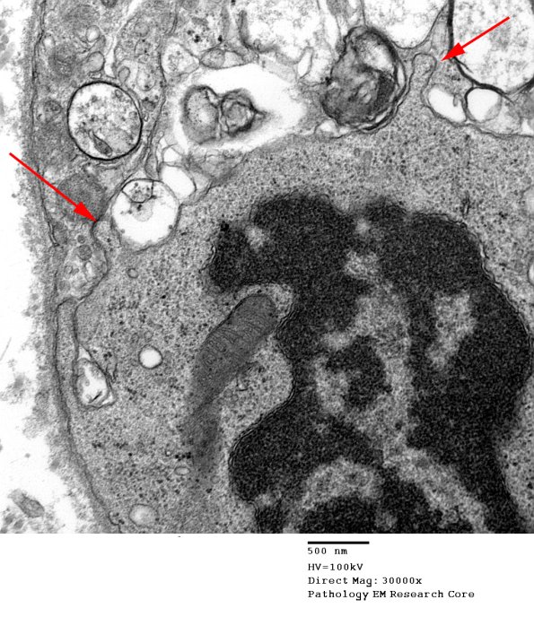 3B3 Axonal Degeneration (Case 4) EM 086 copy - Copy
