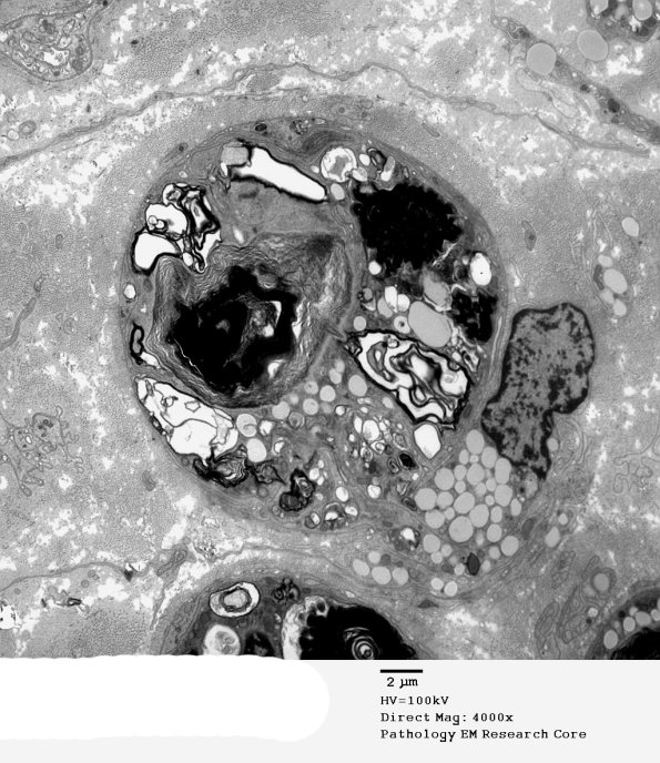 3C1 Axonal Degeneration, macrophage phagocytosis (Case 8) EM 005 - Copy