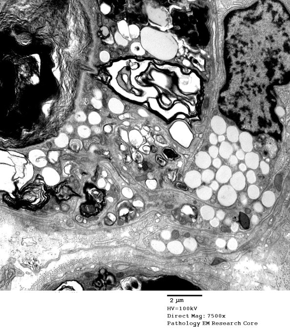 3C2 Axonal Degeneration, macrophage phagocytosis (Case 8) EM 006 - Copy