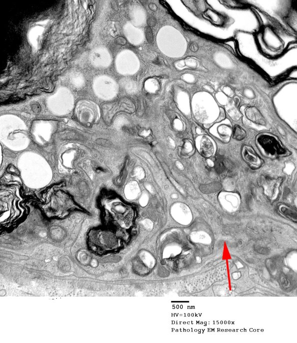 3C3 Axonal Degeneration, macrophage phagocytosis (Case 8) EM 007 - Copy copy