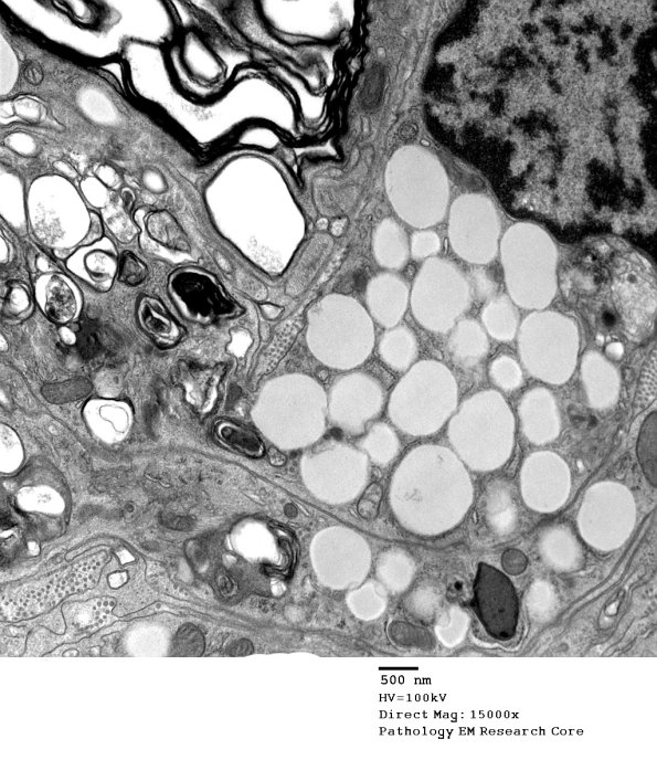 3C4 Axonal Degeneration, macrophage phagocytosis (Case 8) EM 009 - Copy