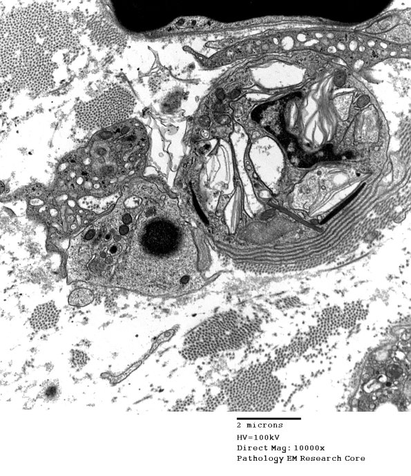 3D1 Axonal Degeneration (Case 4) EM 112 - Copy