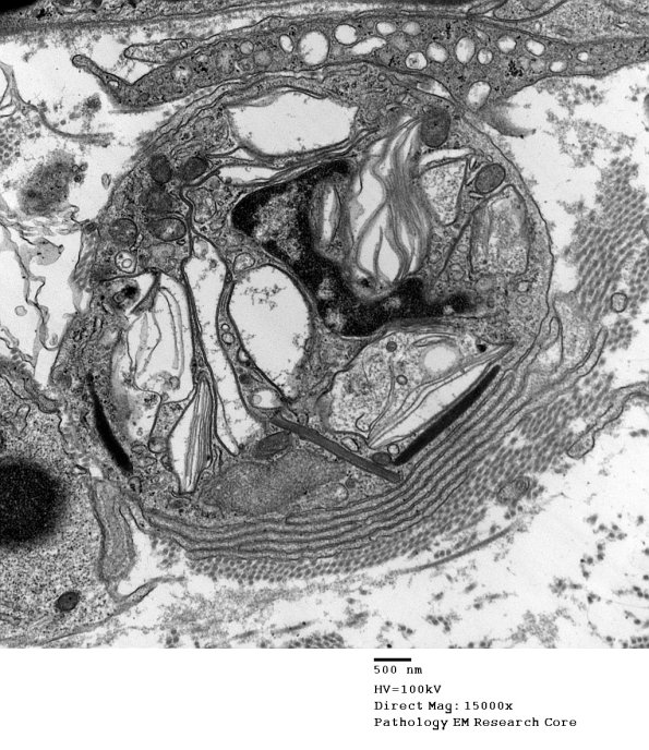 3D2 Axonal Degeneration (Case 4) EM 113 - Copy