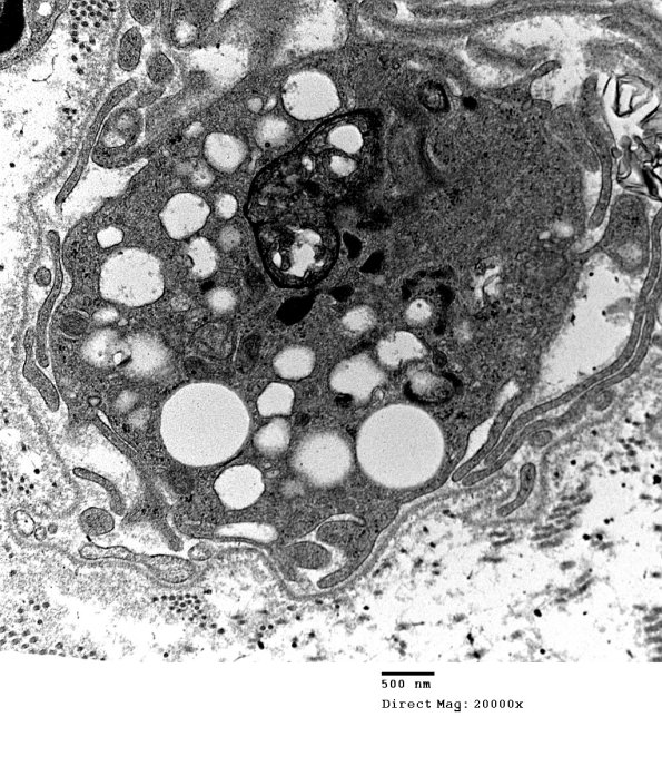3F2 Axonal Degeneration (Case 10) 006 - Copy