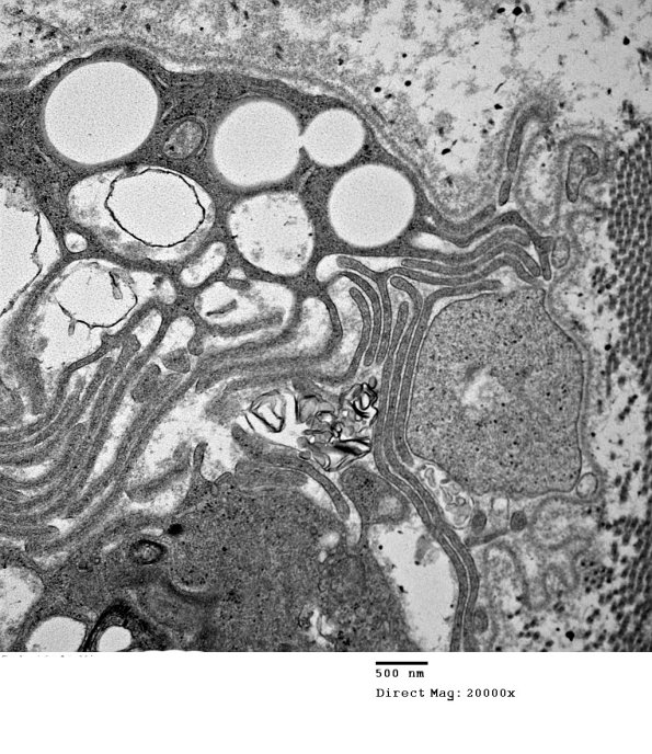 3F3 Axonal Degeneration (Case 10) 046 - Copy