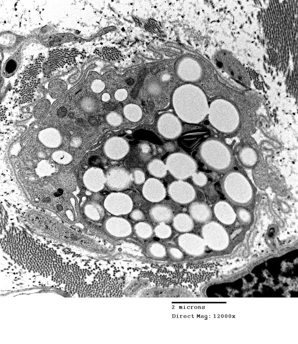 3F4 Axonal Degeneration (Case 10) 012 - Copy