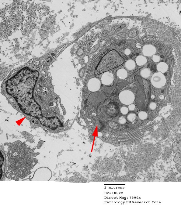 3G1 Axonal Degeneration (Case 4) EM 101 copy - Copy copy