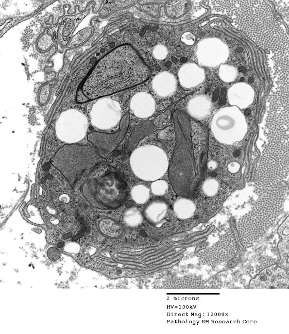 3G2 Axonal Degeneration (Case 4) EM 102 - Copy