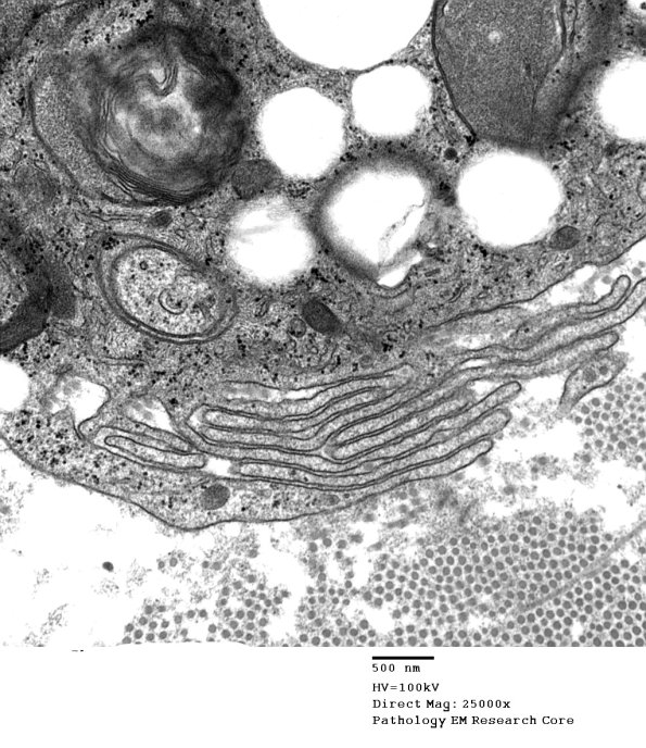 3G3 Axonal Degeneration (Case 4) EM 103 - Copy