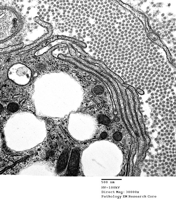3G4 Axonal Degeneration (Case 4) EM 098 - Copy