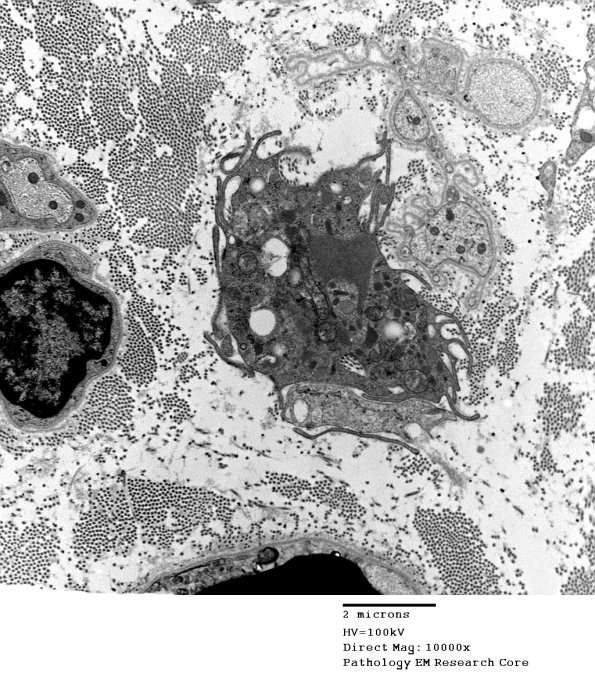 3H1 Axonal Degeneration (Case 11) EM 010 - Copy