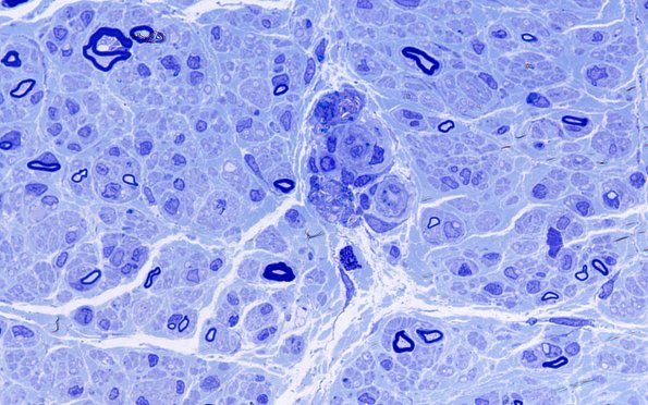 4A00 Macrophages perivascular (Case 12) 100X 1