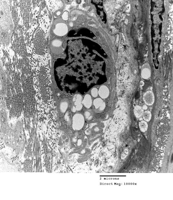 4A1 Axonal Degeneration (Case 10) 008 - Copy