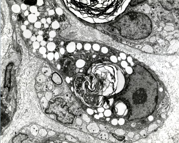 4D2 Case 15 EM 4 - Copy