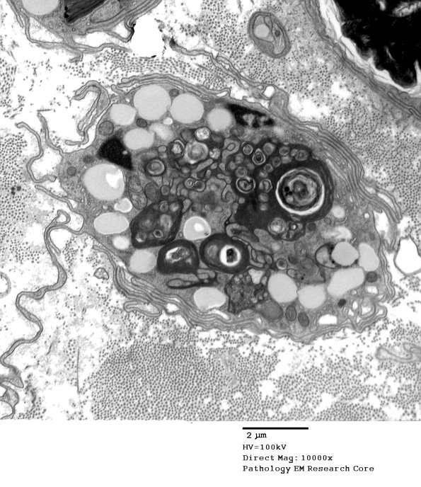 4E1 Axonal Degeneration (Case 8)_018 - Copy
