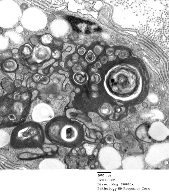 4E2 Axonal Degeneration (Case 8)_019 - Copy