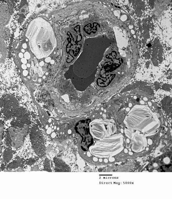 4H1 Axonal Degeneration (Case 10) 035 - Copy