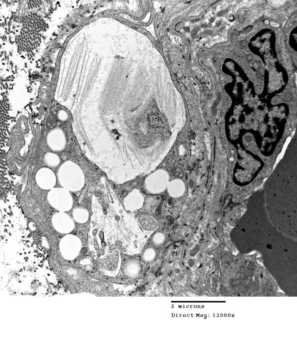 4H2 Axonal Degeneration (Case 10) 036 - Copy