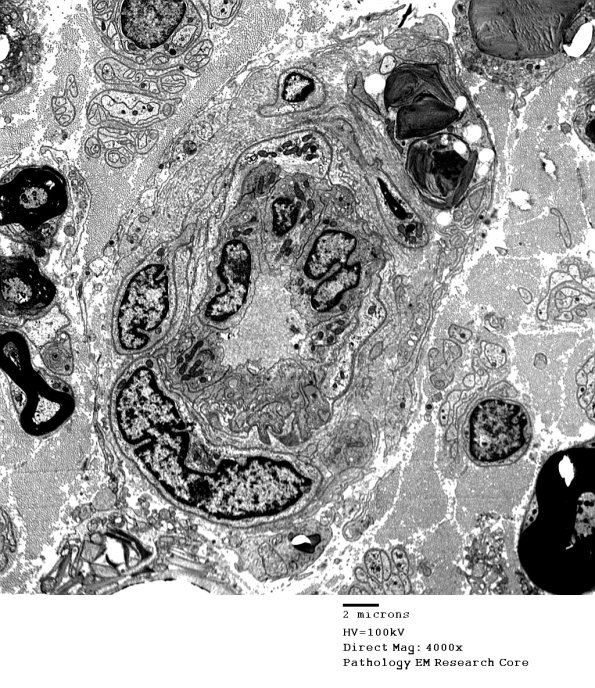 4I1 Axonal Degeneration (Case 4) 021 - Copy