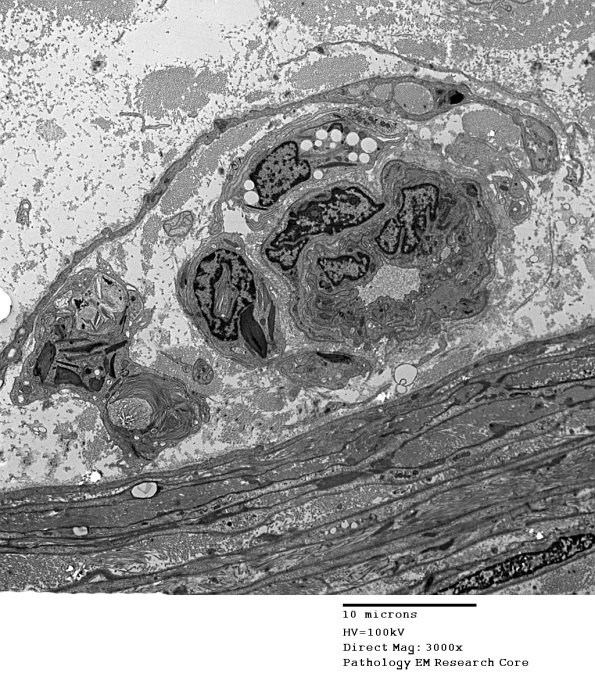 4J1 Axonal Degeneration (Case 4) 045 - Copy
