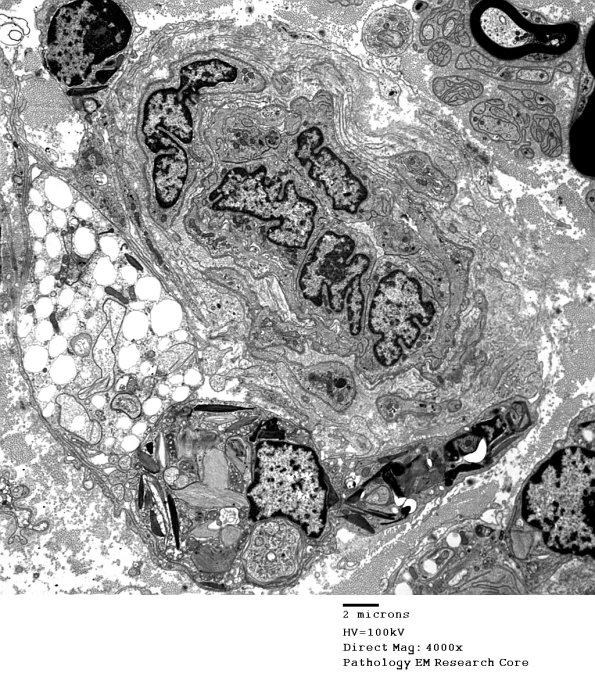 4K Axonal Degeneration (Case 4) 050 - Copy
