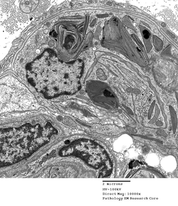 4L2 Axonal Degeneration (Case 4) EM 070 - Copy