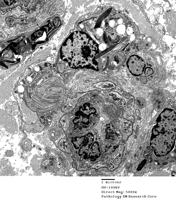 4M Axonal Degeneration (Case 4) 051 - Copy