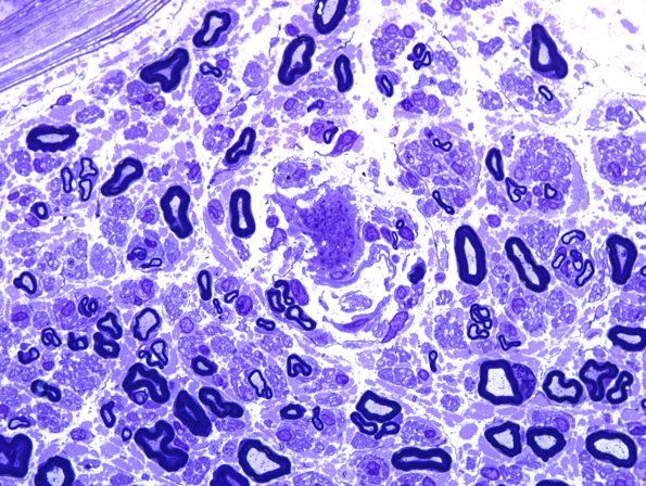 4N1 Axonal Degeneration (Case 17) Plastic2.jpg