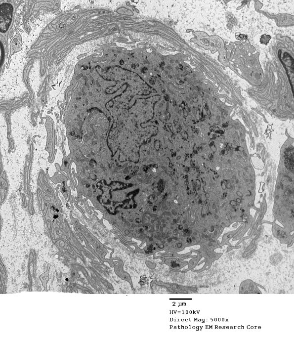 4N2 Axonal Degeneration (Case 17) EM 078 - Copy