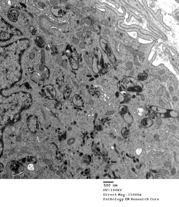 4N3 Axonal Degeneration (Case 17) - Copy