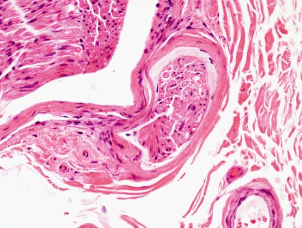 2A Edema, subperineurial (Case 2) H&E 1