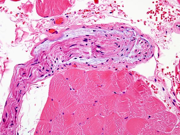 3A Edema, subperineurial (Case 3) H&E 2
