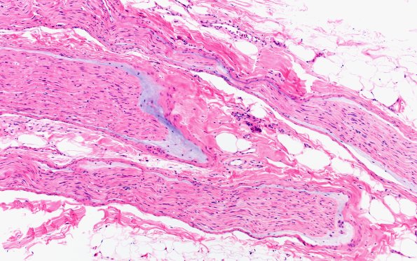 4A1 Edema, subperineurial (Case 4) H&E 1