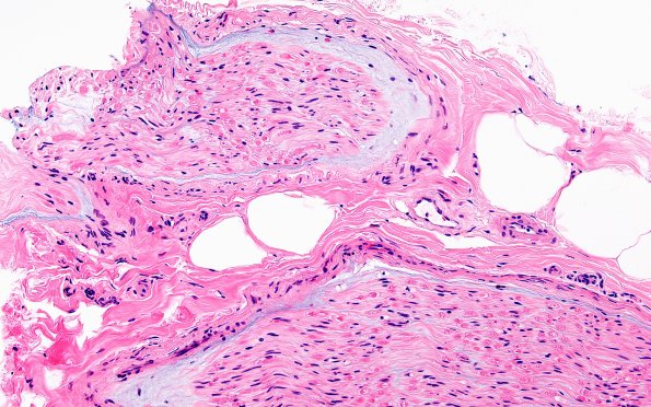 4A2 Edema, subperineurial (Case 4) H&E 2