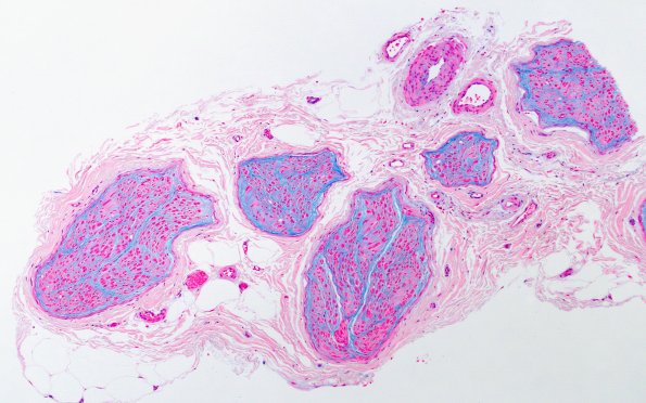 5A1 Edema, subperineurial (Case 5) Alcian Blue 3