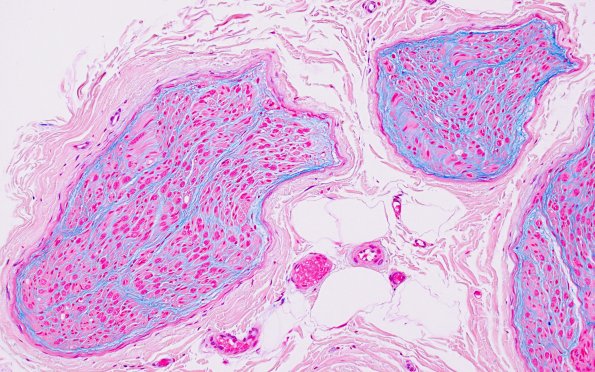 5A2 Edema, subperineurial (Case 5) Alcian Blue 1