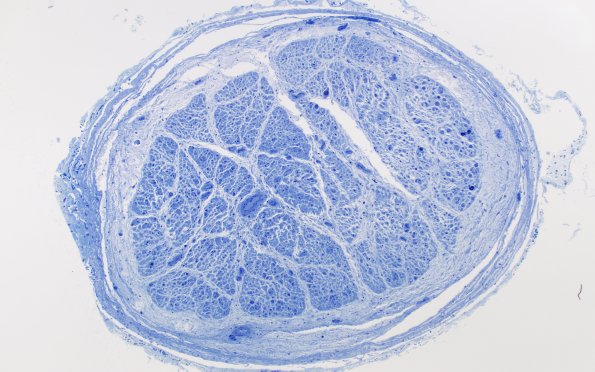 6A1 W24-6103A (Case 6) Subperineurial edema Plastic 10X 1