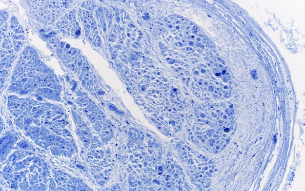 6A2 W24-6103A (Case 6) Subperineurial edema Plastic 20X 1