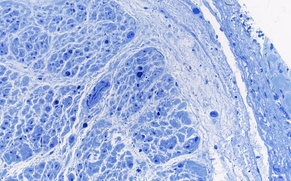 6A3 Nerve, subperineurial (Case 6) 40X 2
