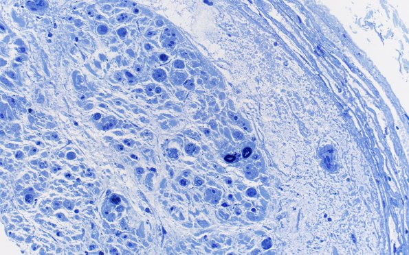 6A4 W24-6103A (Case 6) Subperineurial edema Plastic 40X 1