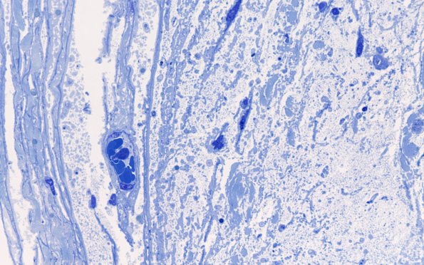 6A5 Nerve, subperineurial & End stage (Case 6) 100X 1
