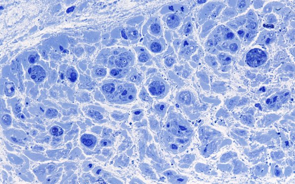 6A6 Nerve, subperineurial & End stage (Case 6) 100X 7