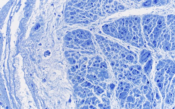 6A7 (Case 6) Subperineurial edema Plastic 40X 2