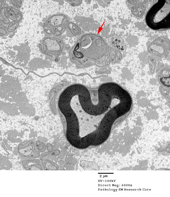 11A1 Axon Degen & NAD (Case 18) EM 091 copy - Copy