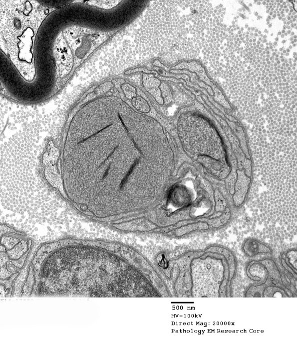 11B1 Axon, growth cone vs dystrophy (Case 19) EM 10 - Copy
