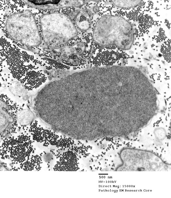 11D1 Axonal Degeneration & Artifact (Case 20 EM 004 - Copy